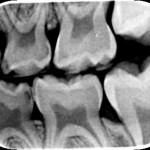 children's teeth x-ray