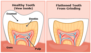 Bruxism